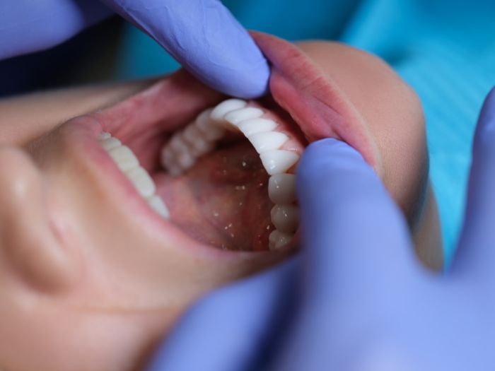 dentist examining patient with veneers