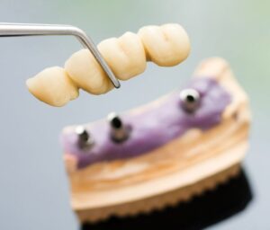 placing dental bridge on implants